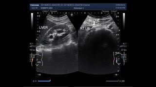 Ultrasound Video showing Focusing the ureteric stone [upl. by Kablesh]