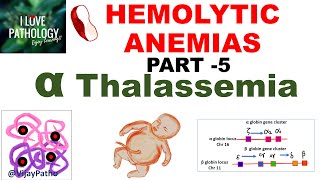 Hemolytic Anemias Part 5 Alpha Thalassemia Pathogenesis types Diagnosis amp Treatment [upl. by Bazluke]