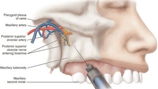 المحاضرة الثامنة  الجزء الاول  LOCAL ANESTHESIA6 “Basic Techniques of Dental Local Anesthesia” [upl. by Anyar]