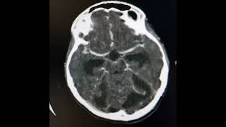 Otomastoiditis Sigmoid sinus thrombosis subdural empyema meningitis and obstructive hydrocephalus [upl. by Langley]