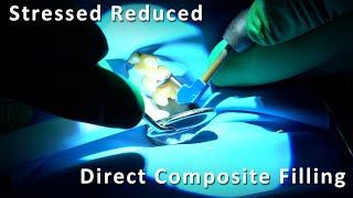 Stressed Reduced Direct Composite Filling  Biomimetic Dentistry [upl. by Faydra]