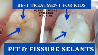 Pit and Fissure sealants  kids cavity Filling  child tooth filling  dental treatment for kids [upl. by Eatnahs]