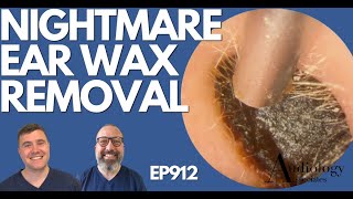 NIGHTMARE EAR WAX REMOVAL  EP912 [upl. by Akerdal]