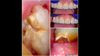 62 Chipped front tooth repair and wisdom teeth extractions [upl. by Fein418]