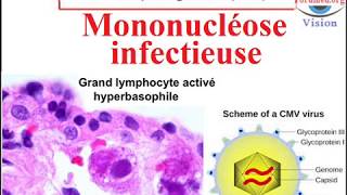 Infection à cytomégalovirus CMV Mononucléose infectieuse [upl. by Alicsirp]