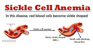 Sickle Cell Anemia  causes symptoms amp treatment  Human diseases [upl. by Hettie123]