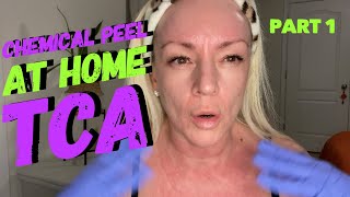 TCA CHEMICAL PEEL at home  Process  Part 1 [upl. by Cence]