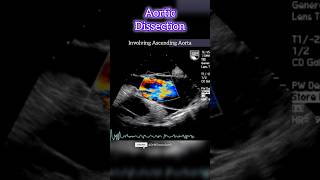 Life threatening Aortic Dissection echocardiography aorticvalve [upl. by Nilatak679]