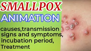 Smallpox symptoms  smallpox treatment  small pox  smallpox animation  smallpox virus  3D [upl. by Niehaus630]