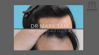 Hair Transplant Before amp After 12 months Final Results Hair Transplant By Dr Mark Tam [upl. by Lebanna]