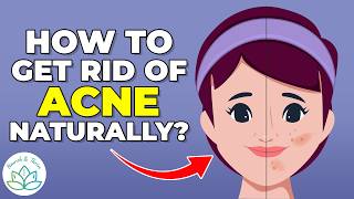 How to Get Rid of Acne Naturally – 4 Lifestyle Changes for Clear Skin [upl. by Odelinda14]