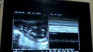 Miscarriage or spontaneous retained abortion 13 weeks [upl. by Siletotsira]