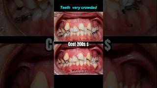 Crowded teeth Braces transformation braces orthodontist dentist bracket [upl. by Noled]