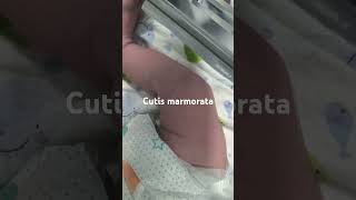 Cutis marmoratanewborn paeds clinical [upl. by Yadahs]