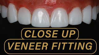 2 Minutes of Close Up Composite Veneer Smiles  Kissdental [upl. by Roosevelt]