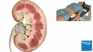 What to expect after your Lithotripsy procedure for Kidney Stones 2020  ESWL  Shockwave Therapy [upl. by Calica]