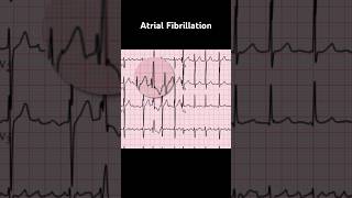 Atrial Fibrillation ECG Ashman phenomenon [upl. by Lienet]