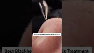 Remove Blackheads amp whiteheads Naturally At Home Remedy [upl. by Brynn]