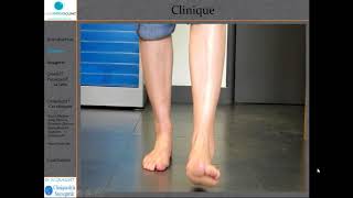 Dr W GRASSET La chirurgie des tendinopathies des fibulaires [upl. by Nylyaj]