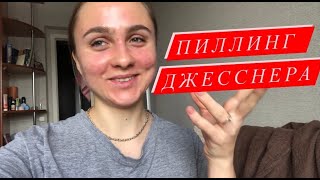 ПИЛЛИНГ ДЖЕССНЕРА Процесс по дням Мой опыт [upl. by Nitsew]