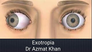 Exotropia  classification and clinical discussion Part 12 [upl. by Ogram575]