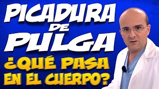 PICADURA DE PULGA  ¿Qué pasa dentro del cuerpo de las personas que la padecen [upl. by Tsnre]