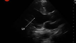 Video 6 Hyperdynamic LV contractility [upl. by Nylatsirk652]