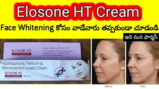 elosone ht cream uses in telugu  hyperpigmentation cream how to apply how many days precautions [upl. by Eornom]