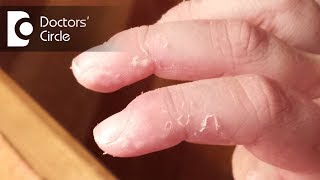 What causes skin peeling of fingers in a child  Dr Varsha Saxena [upl. by Ekeiram]