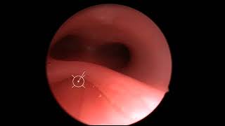 Laryngotracheal Cleft [upl. by Callida]