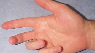 Quick SelfTest for Dupuytren’s Contracture [upl. by Eirrak589]