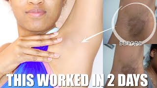 HOW TO LIGHTEN MY DARK UNDERARMS FAST ALL NATURAL DIY [upl. by Cirri]