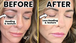 DIY HOODED EYES Fix  TCA Peel Treatment at Home Guide [upl. by Llerut]