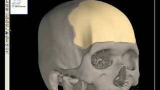 Cranial Implant Design using FreeForm Modelling Plus [upl. by Yanahc]