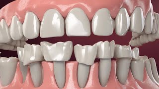 Discover the Benefits of Dental Bridges  How Can They Improve Your Smile [upl. by Ahsuas]