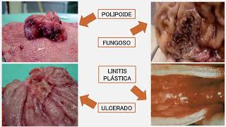 ADENOCARCINOMA GÁSTRICO PRESENTACION DE CASO [upl. by Tai338]