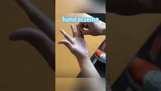 yiganerjing handeczema zudaifu skincare eczema [upl. by Aleris]