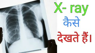 How to read Chest Xray  Hindi language [upl. by Eevets]