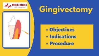 Gingivectomy l treatment of gingival overgrowth and gummy smile l Mediklaas [upl. by Noelani]