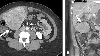 Abdominal mass  Right side flank pain  what to expect during a ct scan exam [upl. by Burkitt]