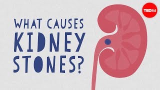 What causes kidney stones  Arash Shadman [upl. by Yenruoc]