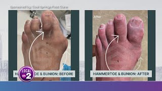 Heres how to fix bunions amp hammertoes on your lunch break [upl. by Sedicla]