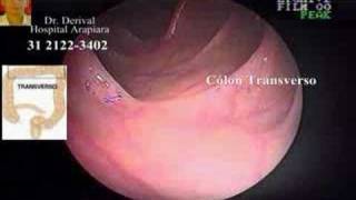 Colonoscopia normal  Dr Derival [upl. by Akimat]