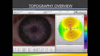 Online Seminar M Korenfeld Use the Keratograph® 5M to Support Your Premium IOL Charges [upl. by Ardnalac]