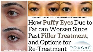 How Eye Bags can Worsen Since Filler Treatment and a Definitive Puffiness Treatment [upl. by Aleahcim199]