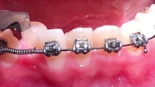 Crimpable stopopen coil spring orthodontics [upl. by Sherlocke810]