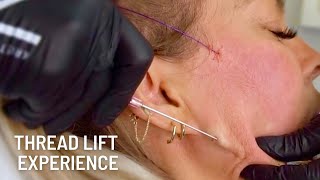 NonSurgical Face Lift  Thread Lift Before And After [upl. by Hathaway]