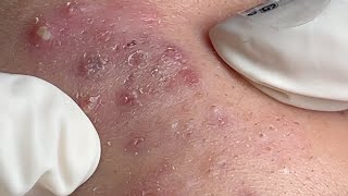 Acne Treatment Huong Da Nang 595  2024 [upl. by Nednal409]