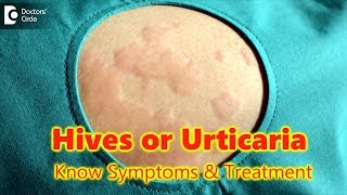 Hives  UrticariaCausesSymptomsTreatment  Skin Rash  Allergy  DrRasya Dixit  Doctors Circle [upl. by Saref]