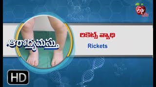 Aarogyamastu  Rickets  8th September 2017  ఆరోగ్యమస్తు [upl. by Sihtam]